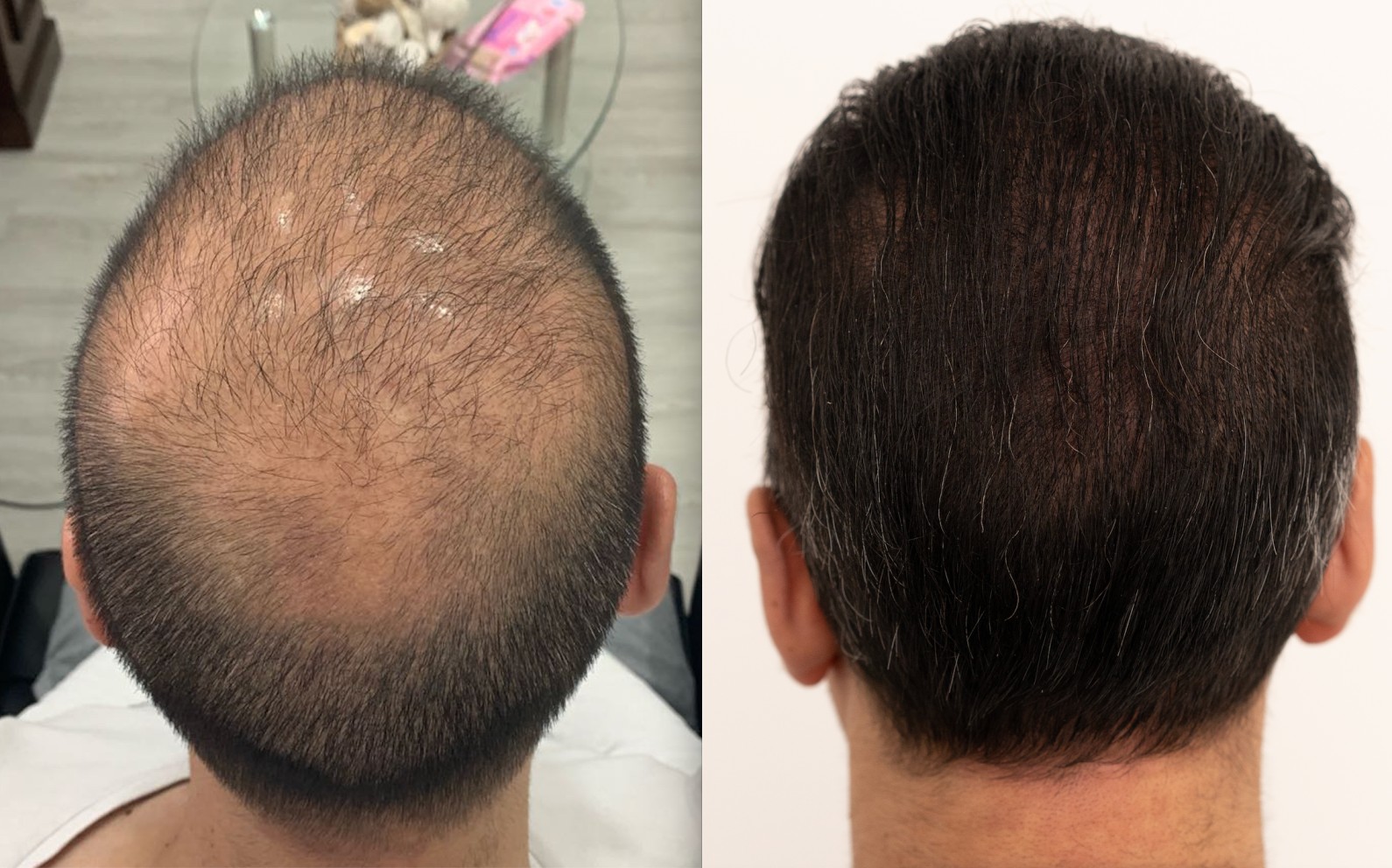 After 5 Failed Attempts Elsewhere, Asif Has Successful Hair Transplant
